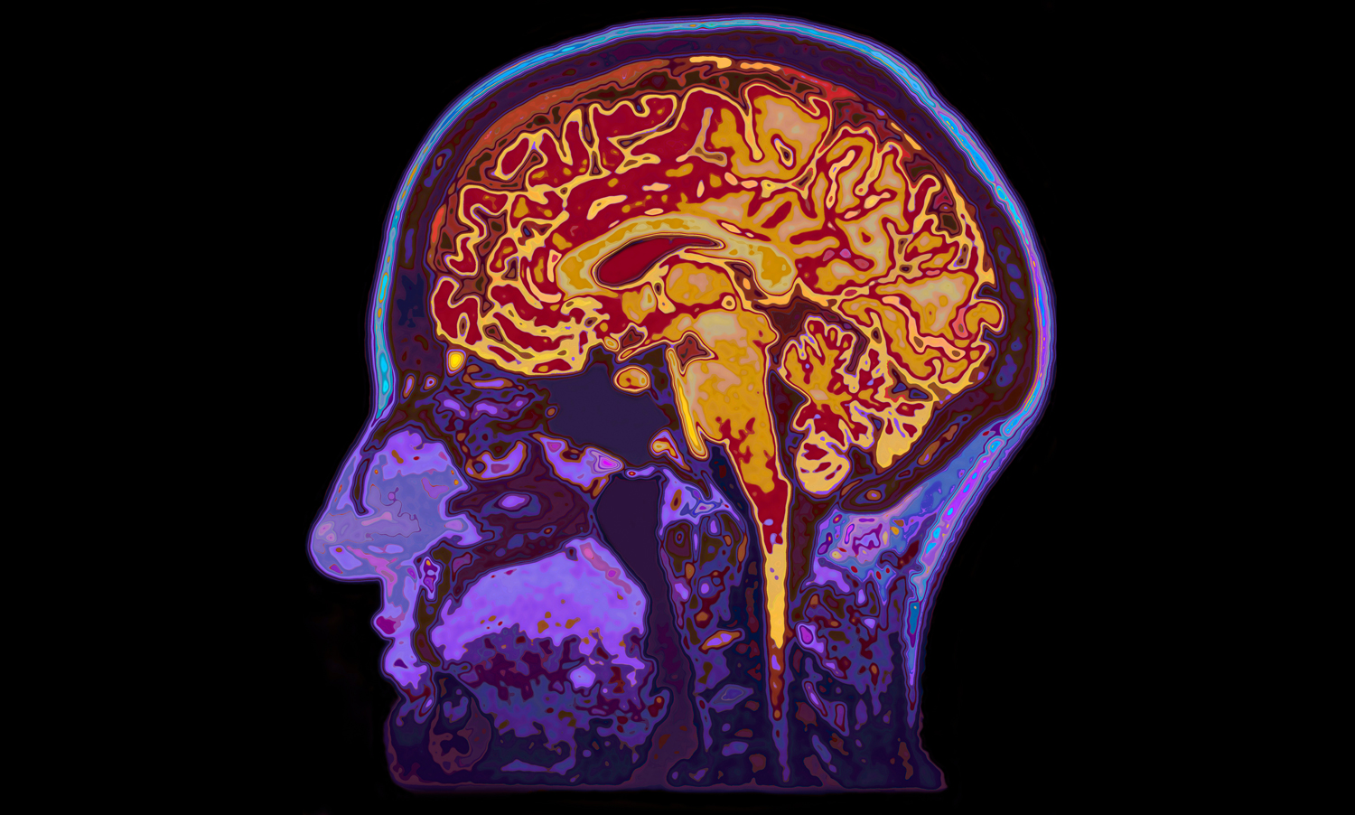 An MRI image of a human brain inside the skull