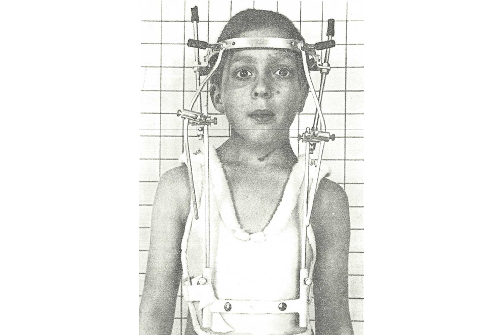 A young Gavin Munro stands with a plastic and metal brace that goes around his upper torso and his head.